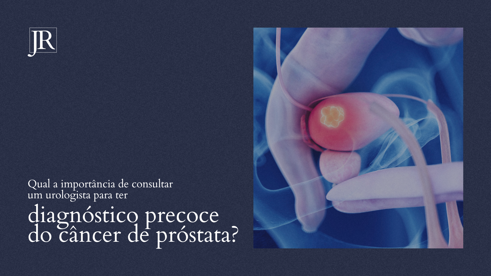 Qual a importância de consultar um urologista para ter diagnóstico precoce do câncer de próstata?