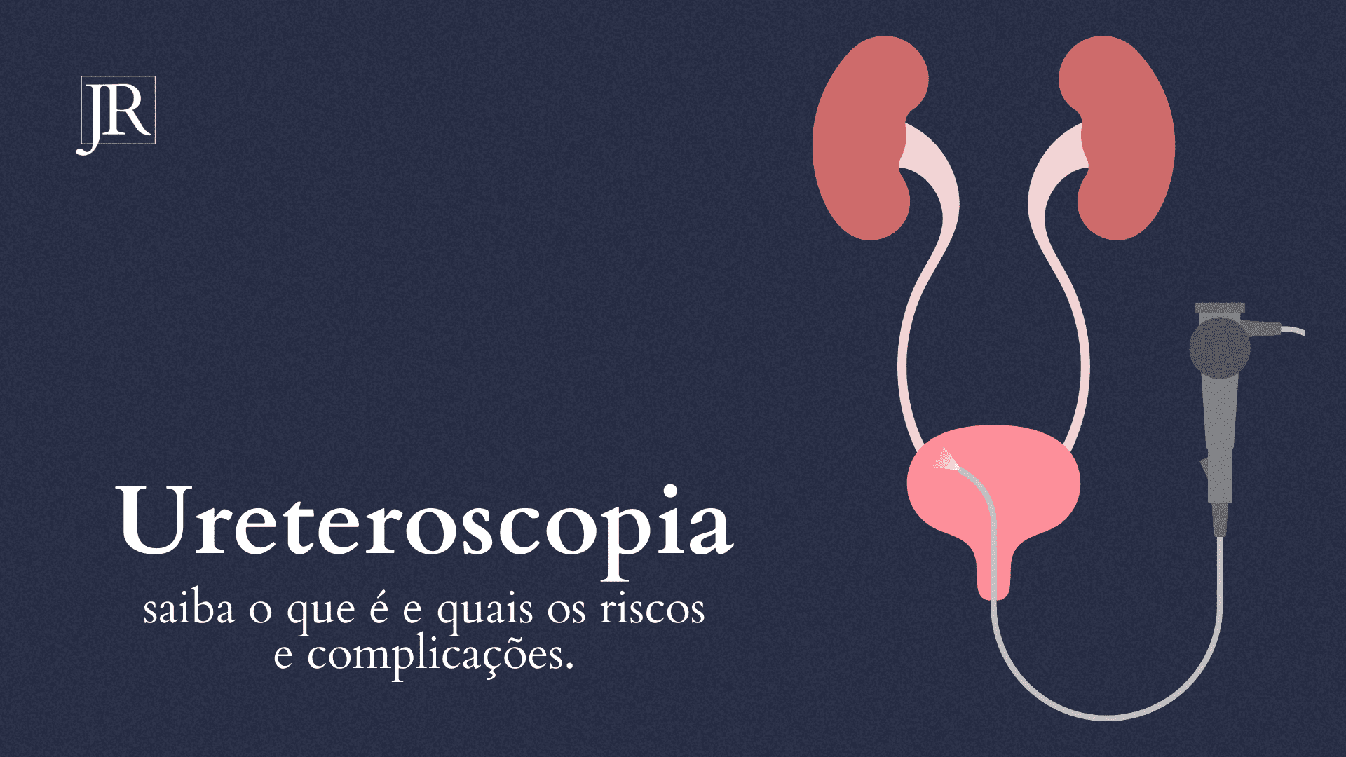 Ureterorrenolitotripsia: saiba o que é e quais os riscos e complicações