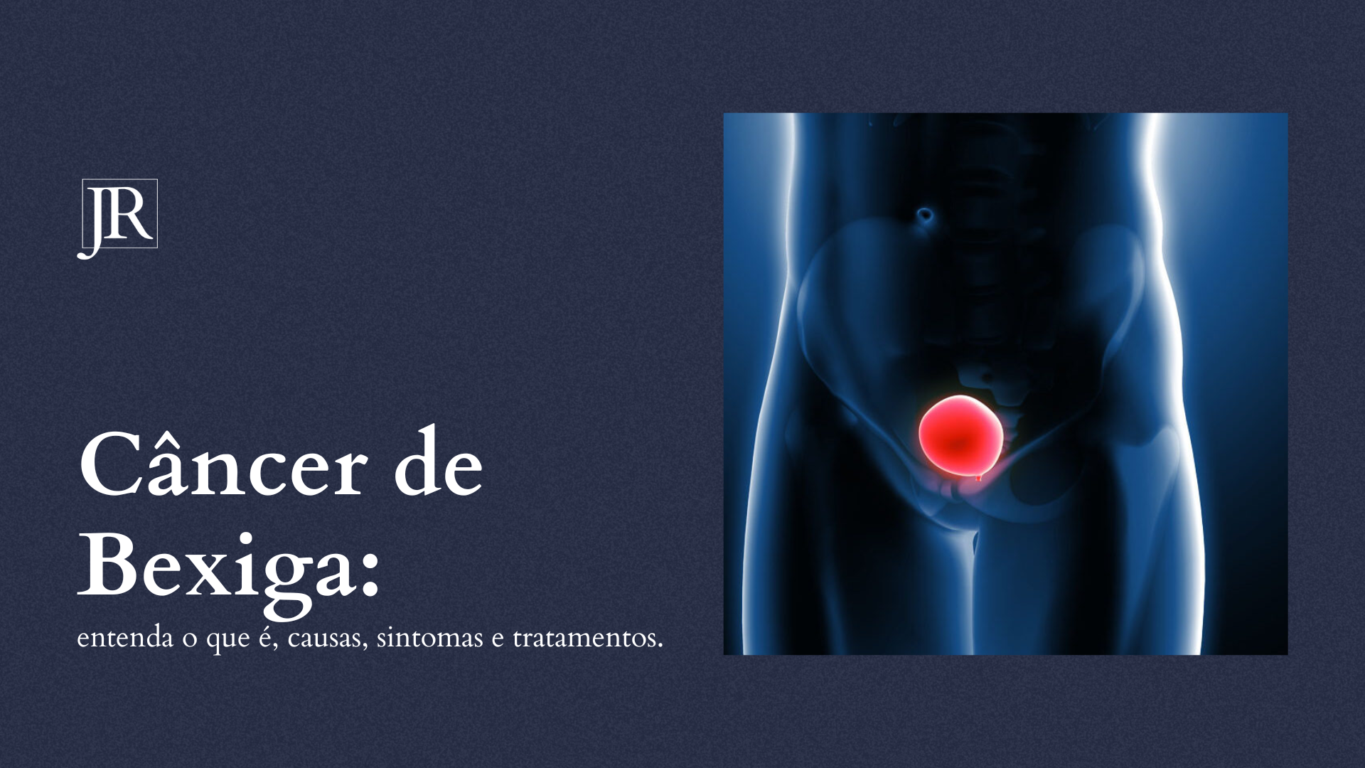 Câncer de Bexiga: entenda o que é, causas, sintomas e tratamentos